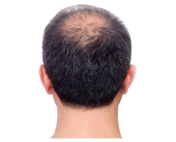 Hair Loss Causes