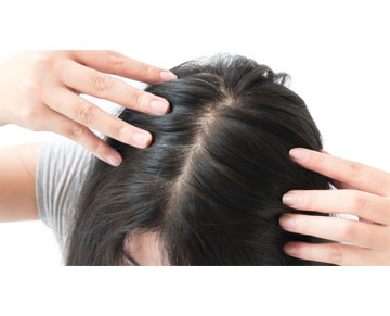 Hair Loss in Women