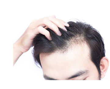 Male Pattern Baldness